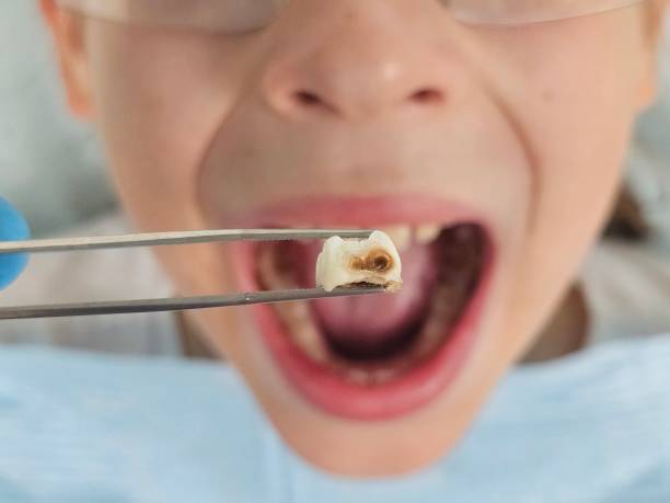 Best Emergency Dentist for Lost Fillings or Crowns in Mccrory, AR